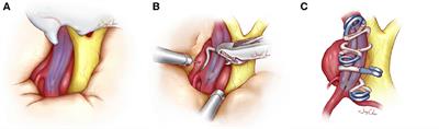 Visualization balloon occlusion-assisted technique in the treatment of large or giant paraclinoid aneurysms: A study of 17 cases series